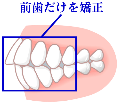 前歯だけの矯正を無理に実行
