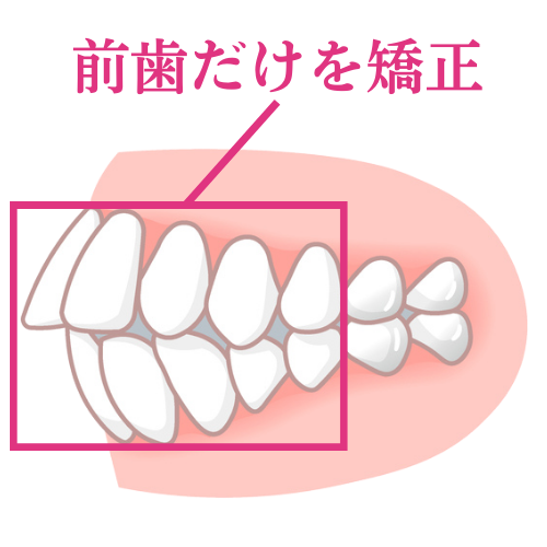 前歯だけの矯正を無理に実行